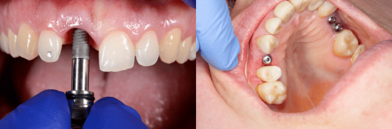 Дентални импланти в Турция – колко ниска е цената? – Sofia Implant Centre